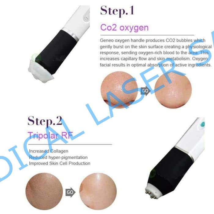 pollogen geneo+u oxygeneo and tripolar options