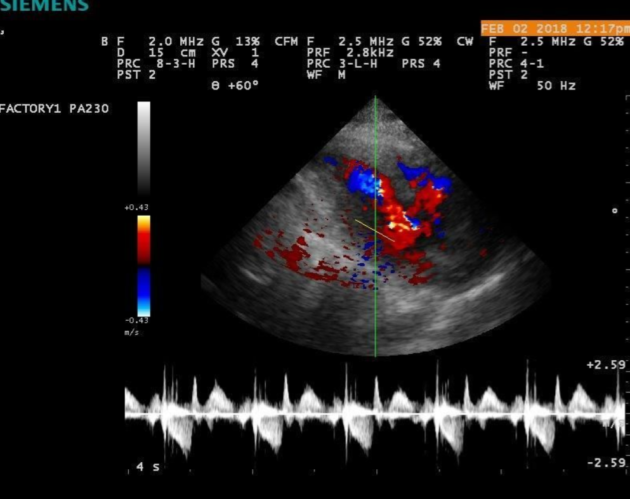 SIEMENS ACUSON P300 ULTRASOUND SYSTEM